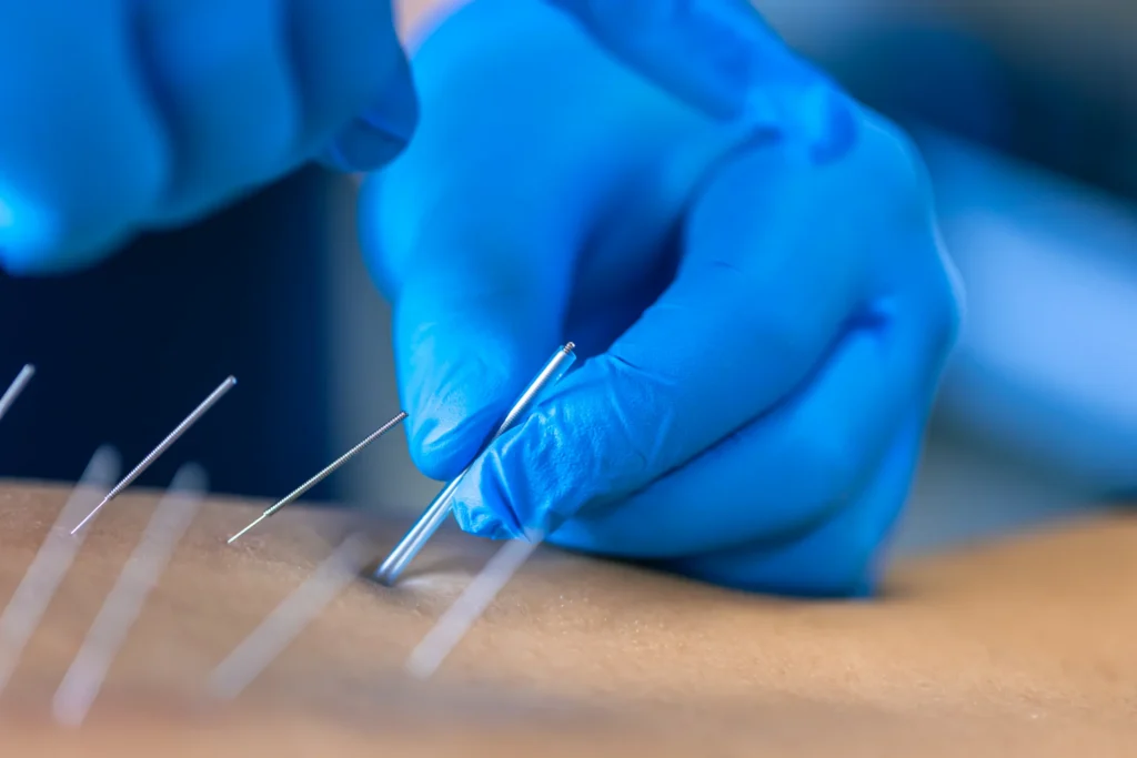Acupuncture