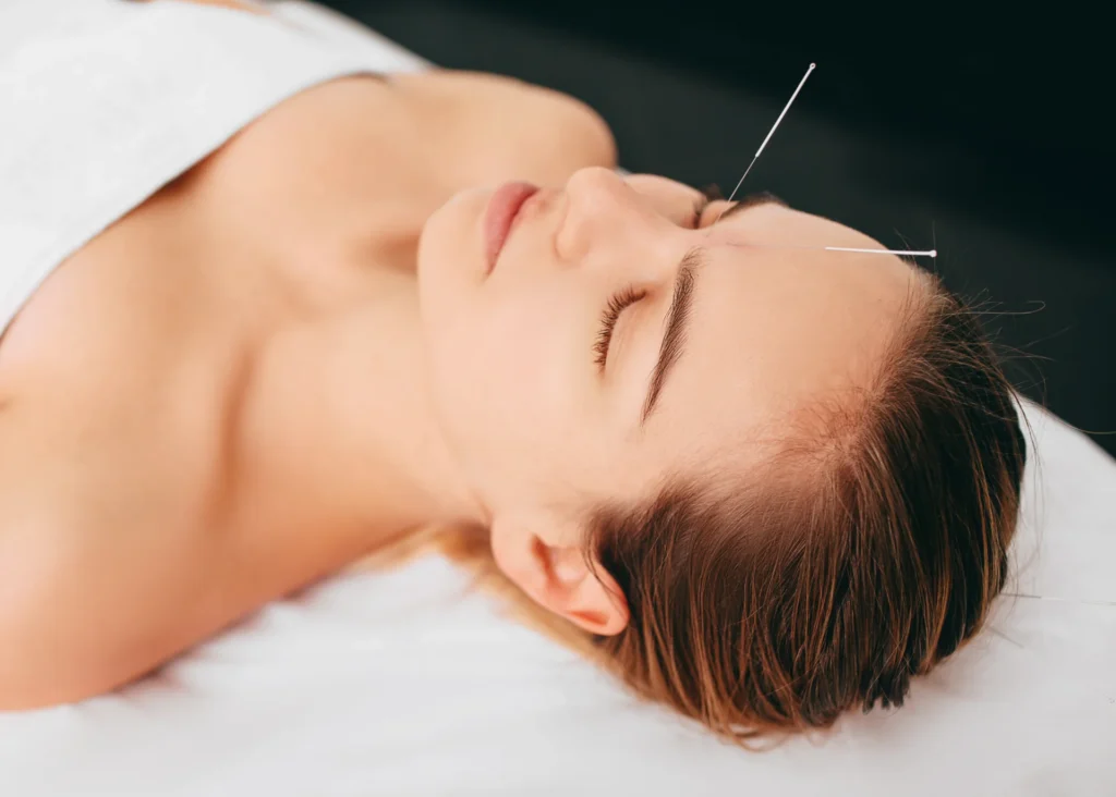 acupuncture treatment for wellbeing and relaxation 2026 01 08 23 31 03 utc