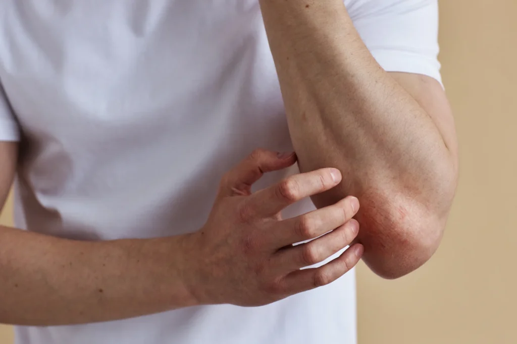 close up of man scratching elbow rash or skin cond 2026 03 20 01 02 02 utc 1