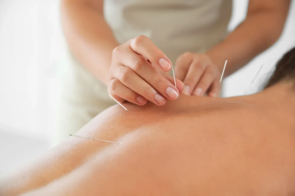 relaxing acupuncture session for health and wellne 2026 03 27 02 11 38 utc